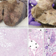 The lungs of someone who died from covid-19, with the images from the bottom taken under a microscope.